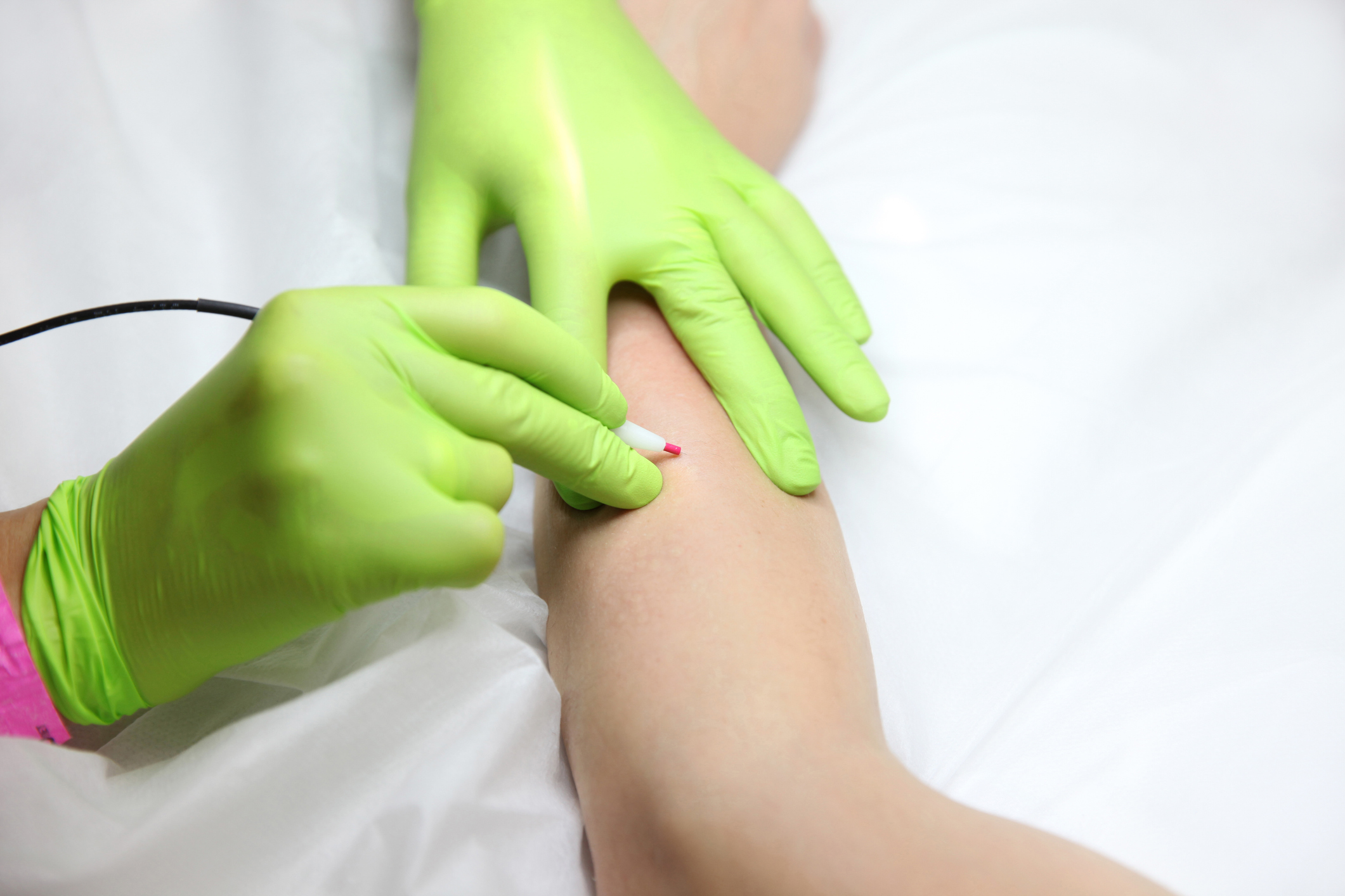 Cosmetologist in gloves makes hair removal on the female hand with the help of the device for electroepilation